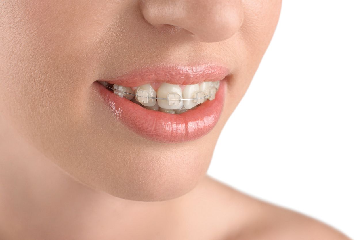 Clear braces Types, pros and cons, price and more.