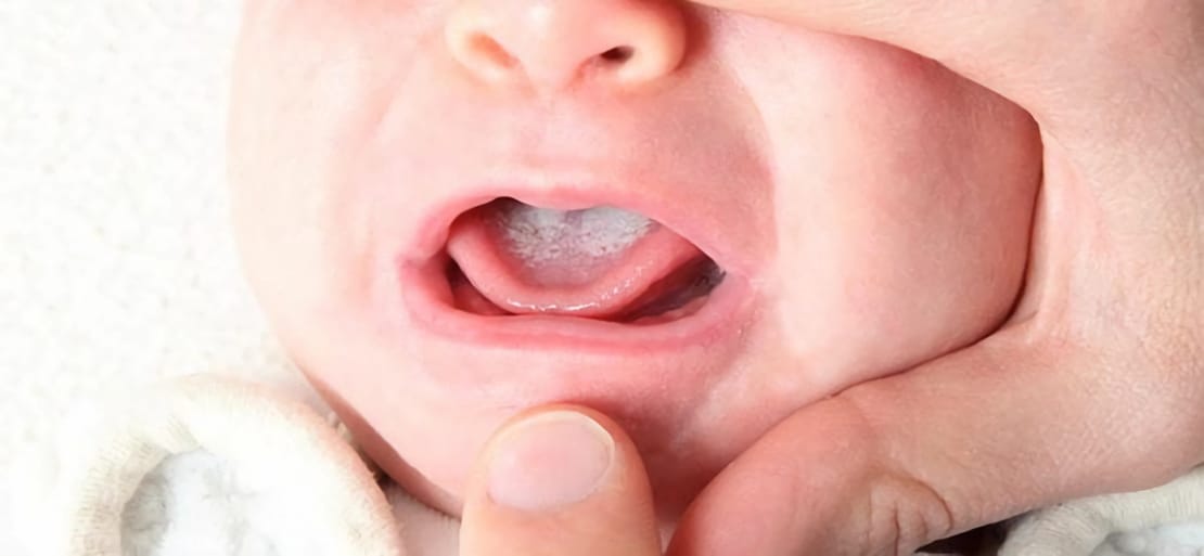 oral yeast infection or thrush