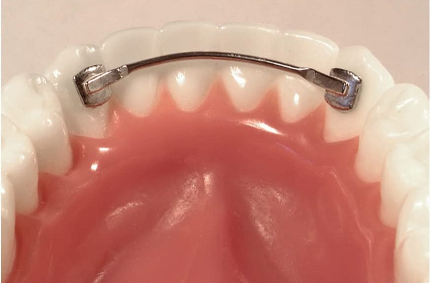 Dental retainers types, prices, materials, and uses