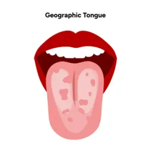 Geographic Tongue: Causes, Symptoms, Treatment, and Prevention