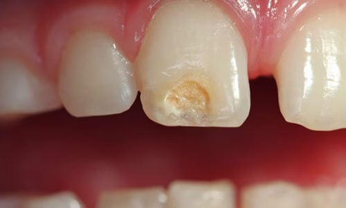 Enamel hypoplasia causes, treatment, and prevention!