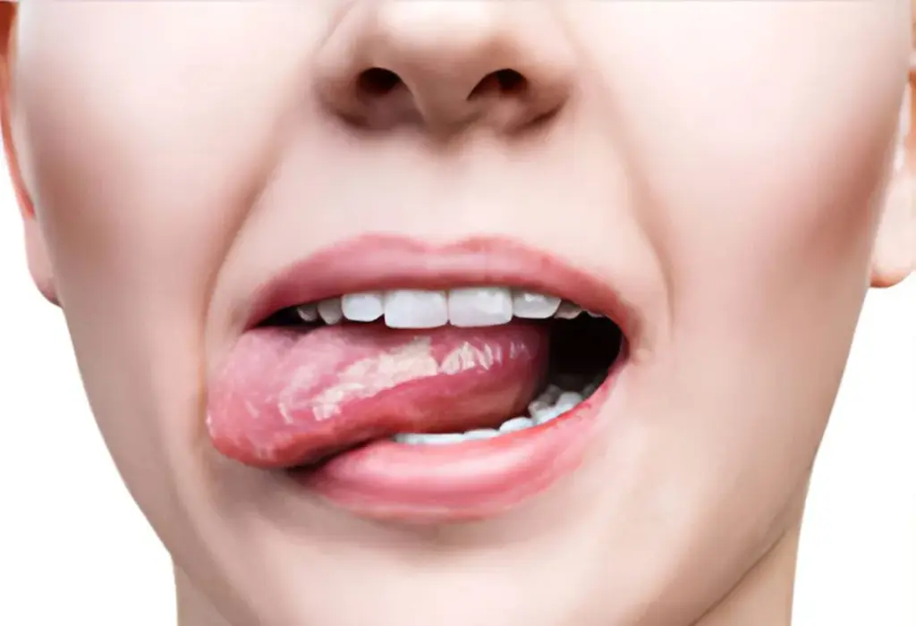Oral Leukoplakia | Oral Pathology