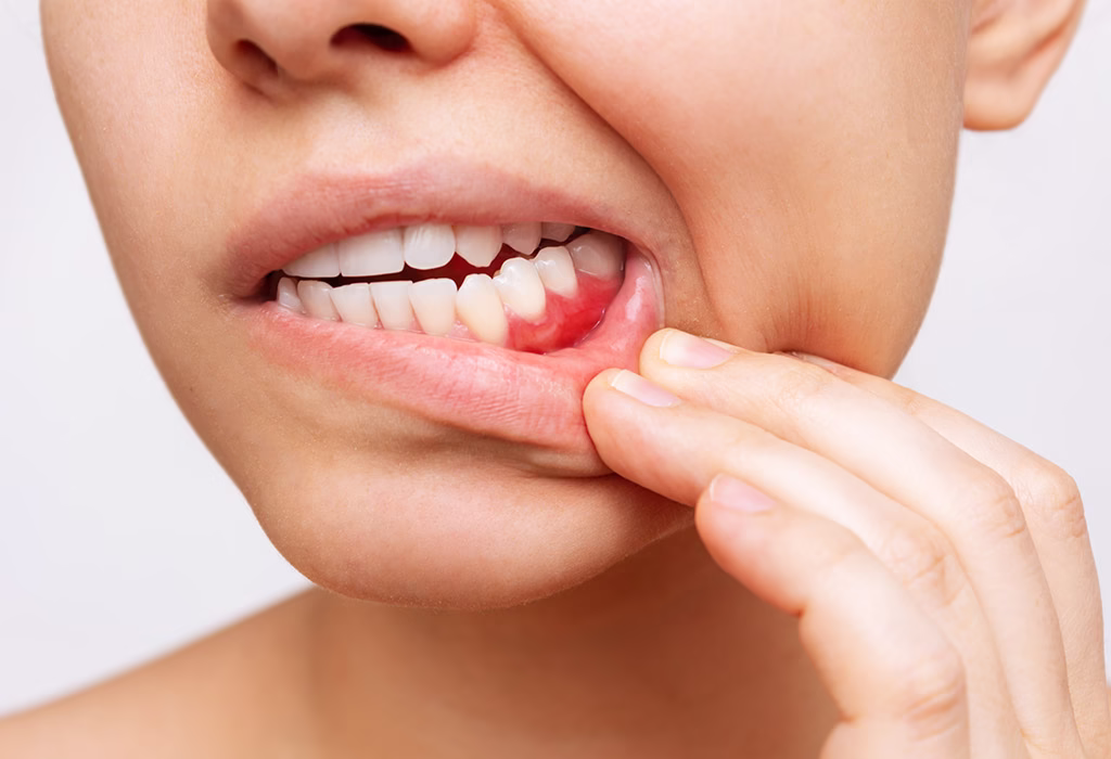 Stomatitis, causes, symptoms, treatments, and prevention!