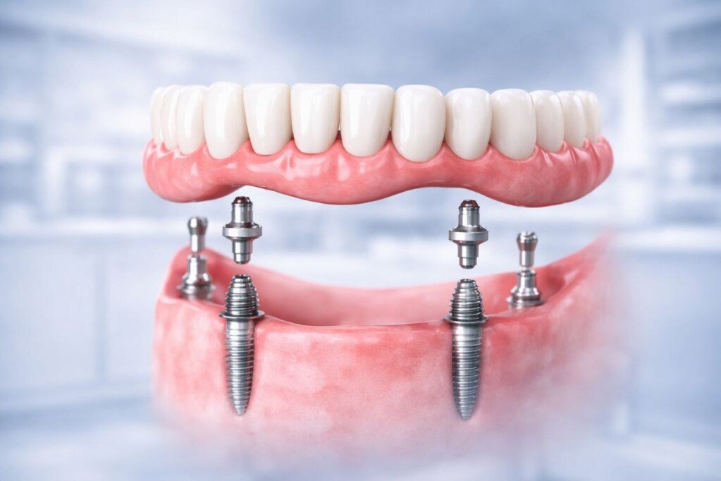 All-on-4 Dental Implants: Cost, Procedure, Recovery & Pros and Cons