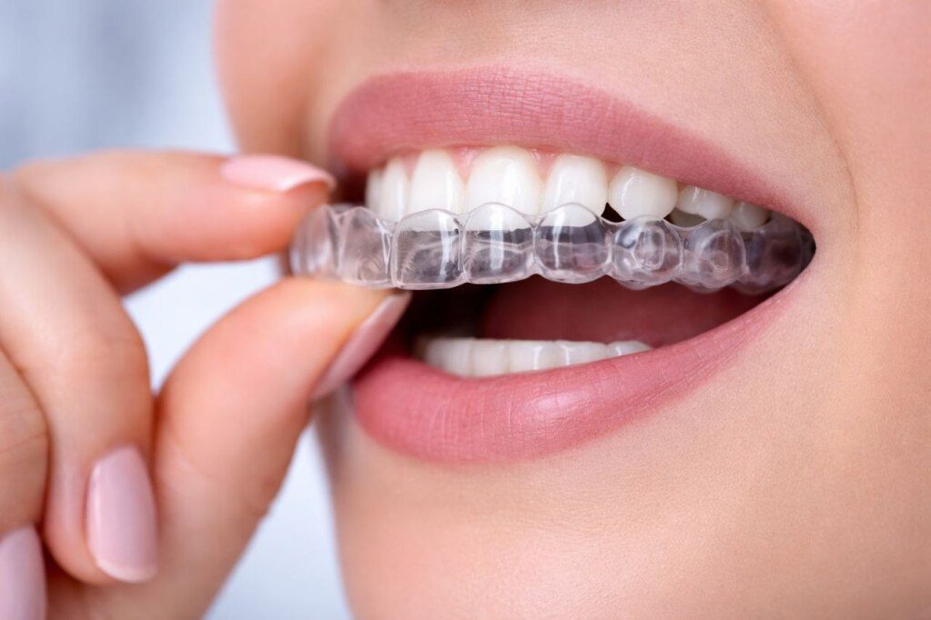 Invisalign Express: Cost, Treatment Time & Who It’s For