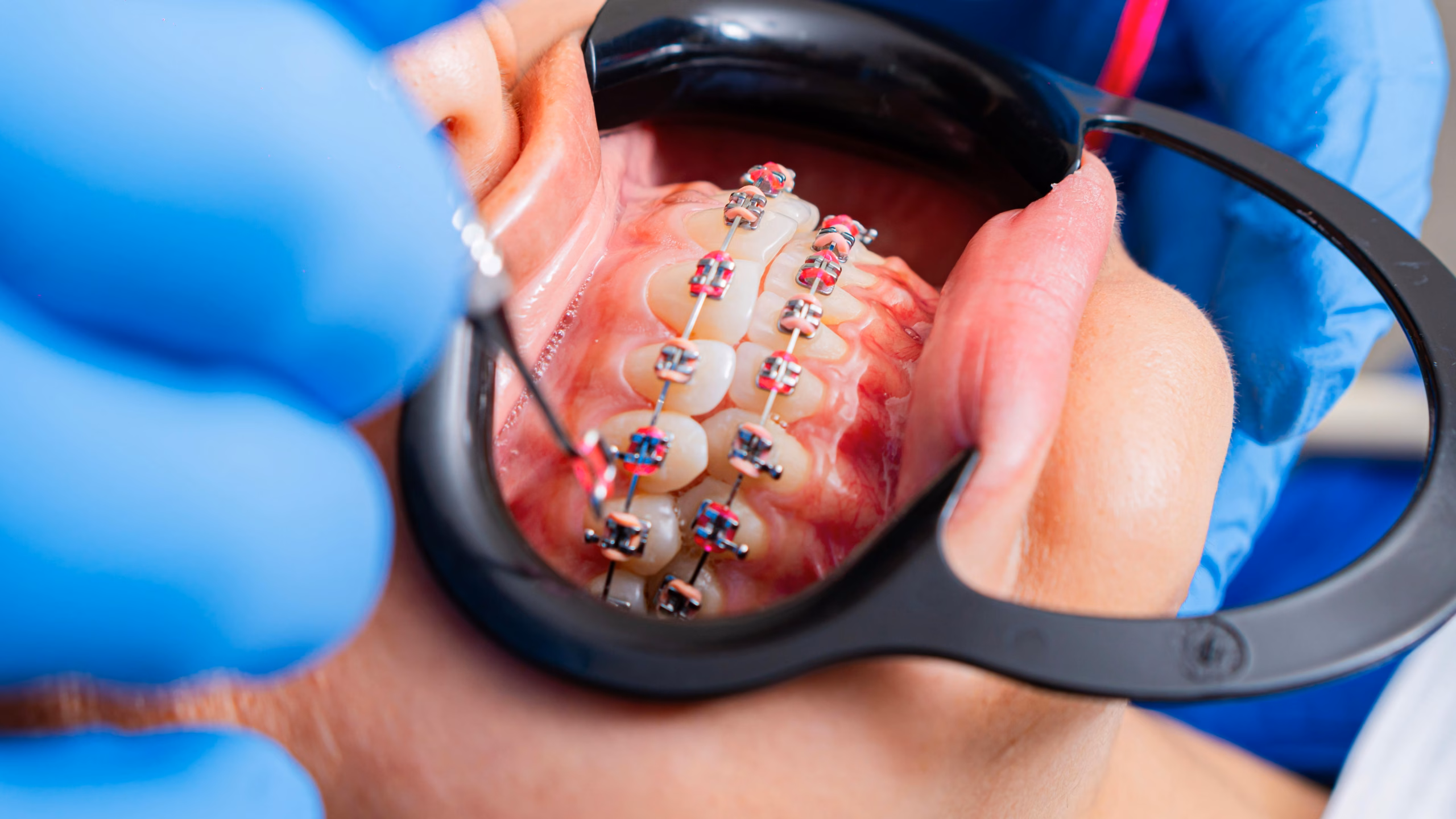 Metal Braces: Cost, Treatment Time, Pros & Cons Explained