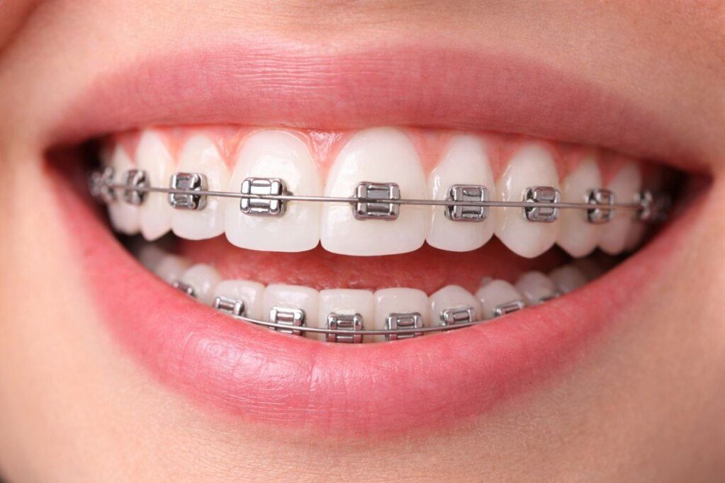 Damon Braces: Cost, Benefits, vs Traditional Braces & Invisalign