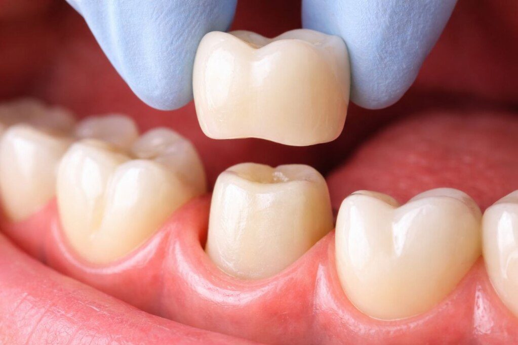 Dental Crown: Cost, Types, Procedure & How Long It Lasts