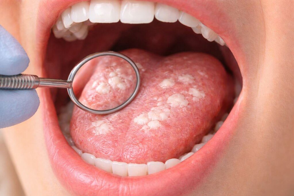 Oral Thrush: Symptoms, Causes, Treatment & How to Get Rid of It