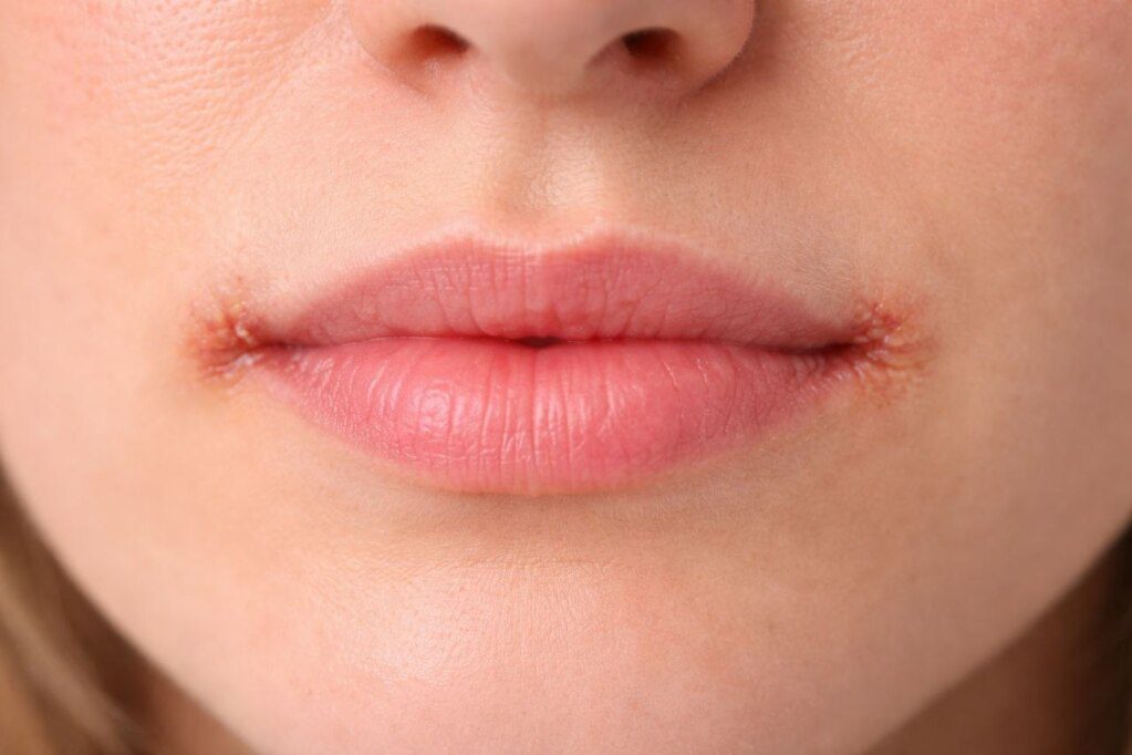 Cracked Corners of the Mouth: Causes, Treatment & How to Heal Fast