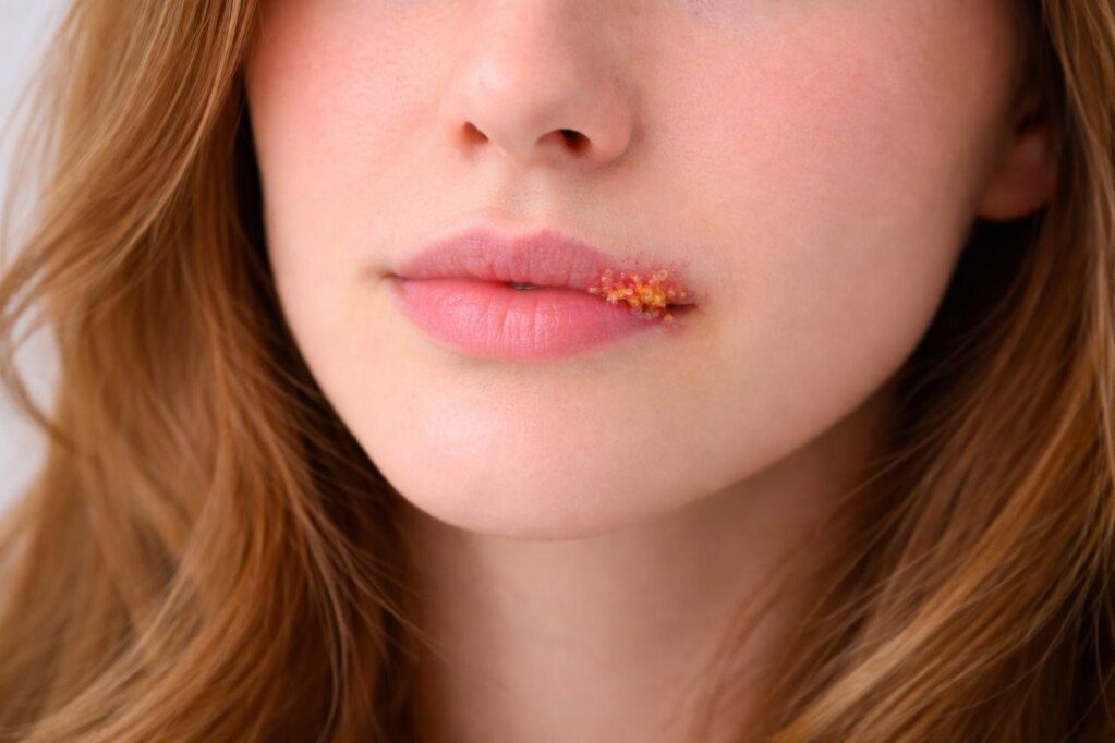 Cold Sores: Causes, Symptoms, Treatment & How to Prevent Outbreaks