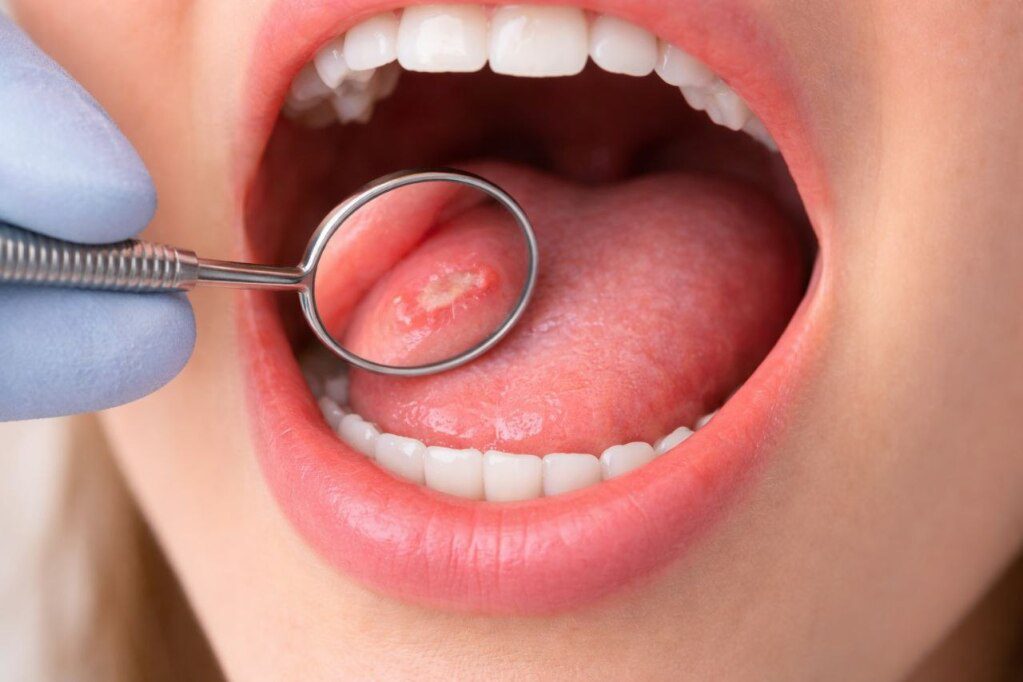 Canker Sores: Causes, Treatment & How to Heal Them Faster