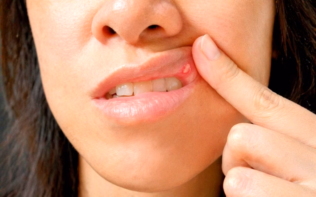 Mouth Ulcers: Causes, Treatment, Types, and When to Worry