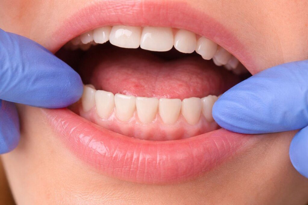 White Gums: Causes, Symptoms, and When to Worry