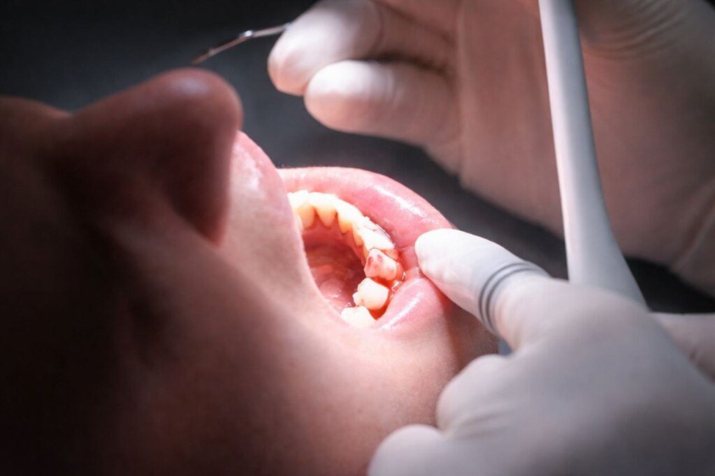 Bleeding Gums: Causes, Treatment, and When to Worry