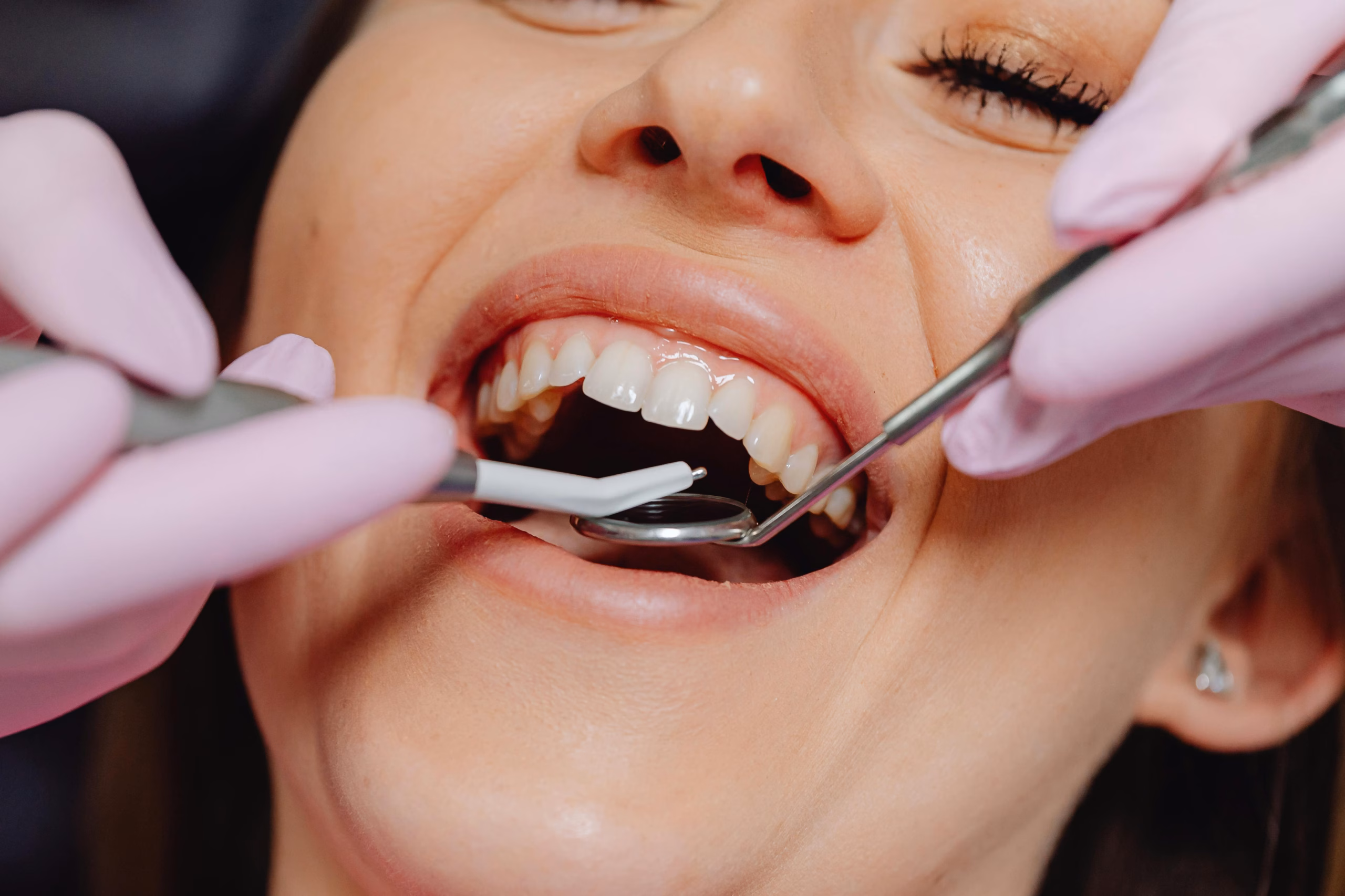 Gingivectomy: Procedure, Recovery, Cost & When It’s Needed