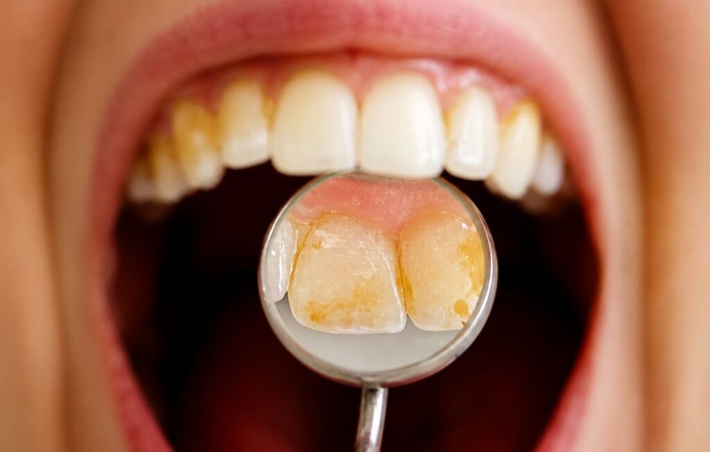Dental Fluorosis: Causes, Symptoms, Prevention & Treatment