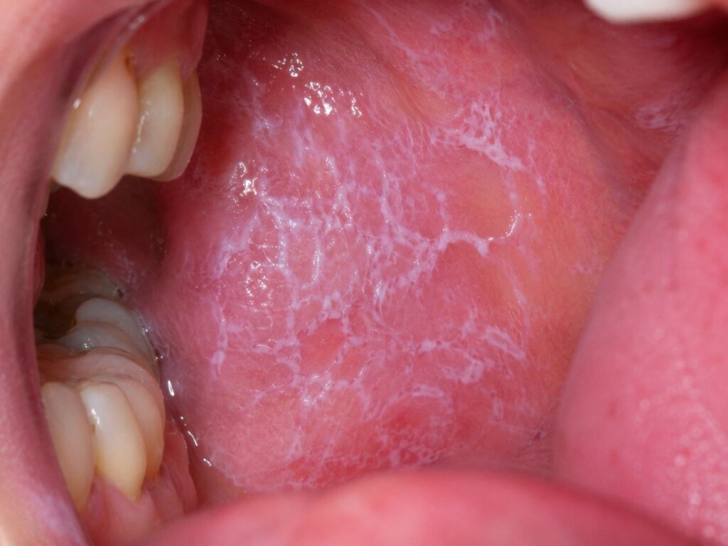 Oral Lichen Planus: Symptoms, Causes, and Treatment Options