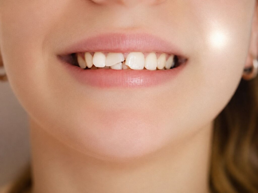 Broken Tooth: Symptoms, Causes, and What to Do Next