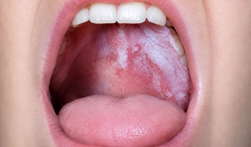 Oral Leukoplakia: Causes, Symptoms, Risk Factors & When It’s Dangerous